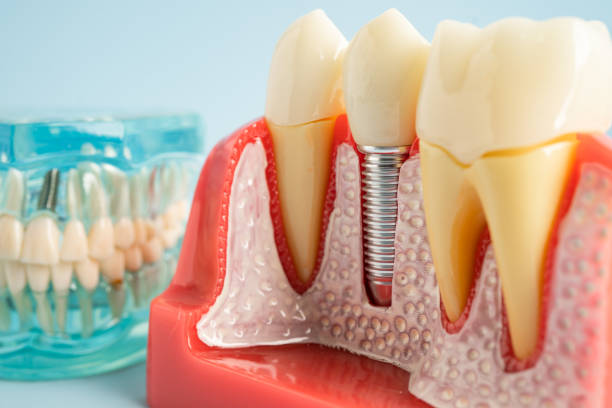 Best Dental Inlays and Onlays  in Mulberry, IN